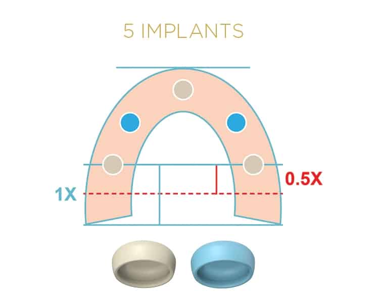 Locator Fixed® Processing Package Blue x 1 – Image 2